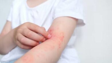 مسبب غير متوقع للأكزيما