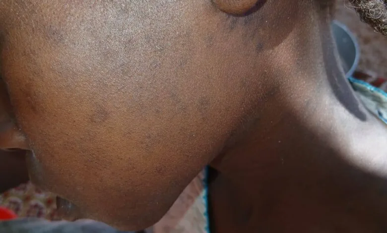 كارثة صحية تضرب كبكابية والأرقام صادمة